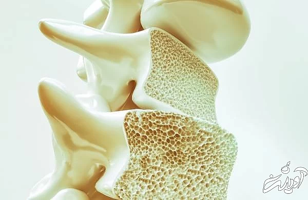 چای لیمو مضر برای پوکی استخوان پوکی استخوان